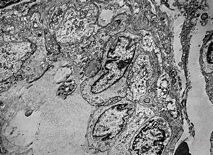 F,6m. | capillary hemangioma - hard palate